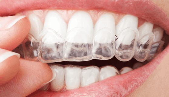 Promociones dentales en Cuernavaca del Consultorio Dental Zmile