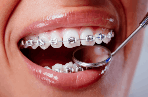 Promociones dentales en Cuernavaca del Consultorio Dental Zmile